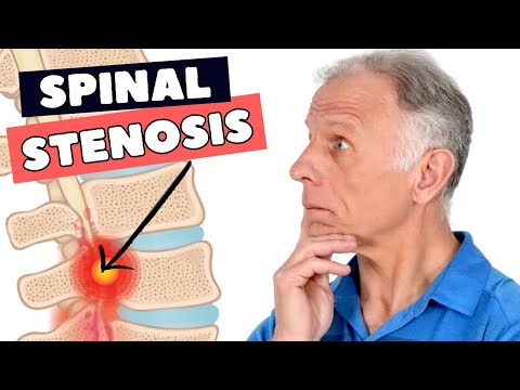 8 Fixes That Can Greatly Help Lumbar Spinal Stenosis