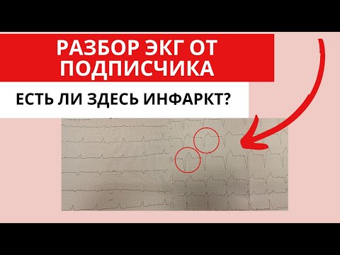 Разбор ЭКГ от подписчика. Можно ли увидеть инфаркт при кардиостимуляторе?