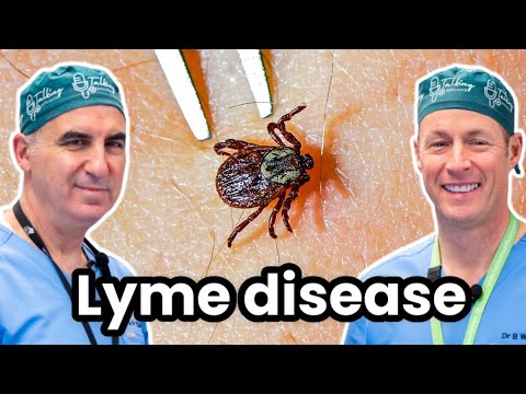 Lyme Disease and Ticks - Causes, Treatments and More