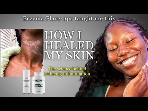 Healing My Skin: My Eczema Story& What helped my Hyperpigmentation