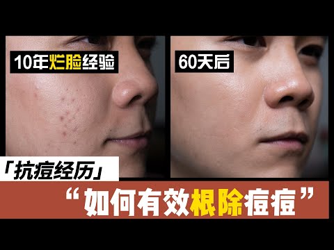 How to treat acne and acne scar? Niacinamide saves my face!