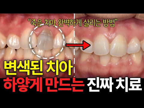 누런 앞니, 변색된 앞니 치료하는 유일한 방법