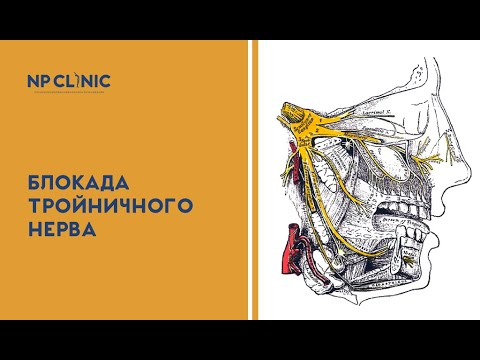 Блокада тройничного нерва