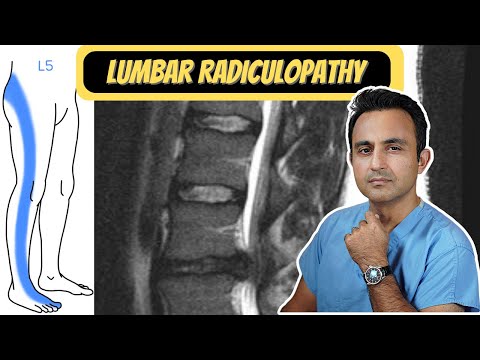 Lumbar Radiculopathy ("Sciatica")