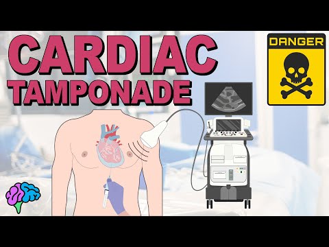 Cardiac Tamponade Made Simple
