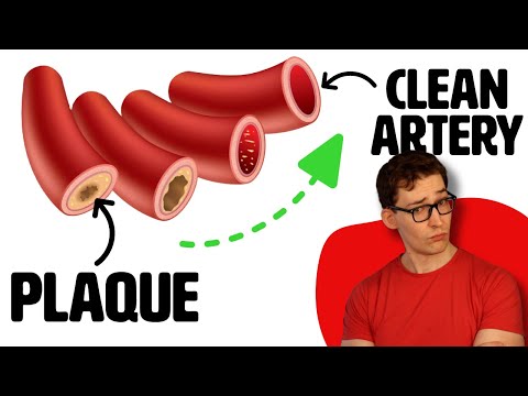 4 Factors that Clear Plaque in your Arteries