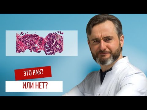 How to spot stage 1 prostate cancer: doctor's advice