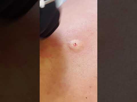 BACK CYST WITH A BONUS! PT 6