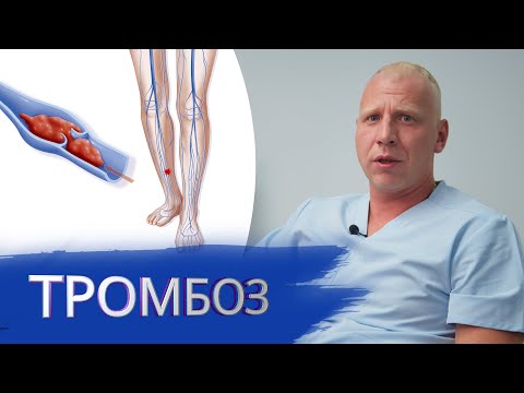 Тромбоз нижних конечностей | Тромбоз поверхностных вен