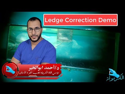 Ledge Correction Demo Mixed Manual and Rotary techniques