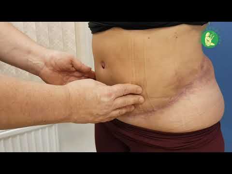 Юлия - 2 месяца после абдоминопластики