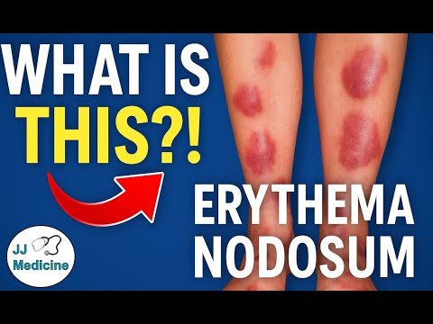 Erythema Nodosum (Red Lumps on Legs) | Causes, Signs & Symptoms, Diagnosis, Treatment