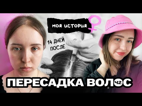 14 дней после пересадки волос. Метод FUE. Честный отзыв.