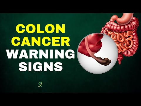 8 Warning Signs of Colon Cancer You Should Never Ignore