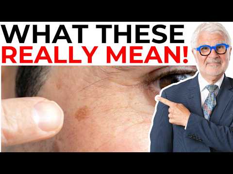 What Dark Spots on Your Skin Really Mean!