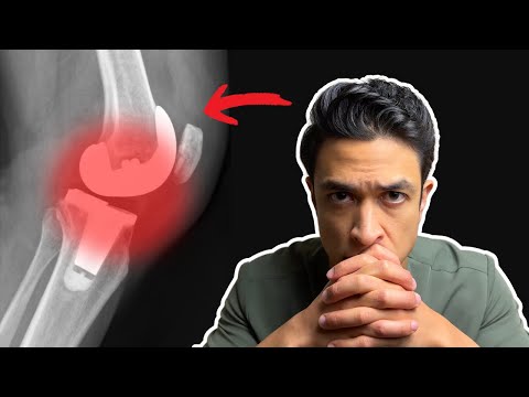 The common knee replacement mistake you must avoid