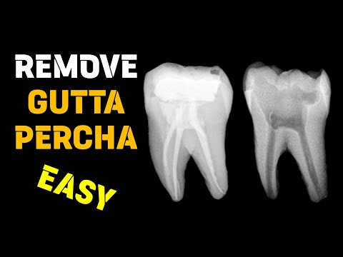 Gutta percha removal | Endodontic retreatment