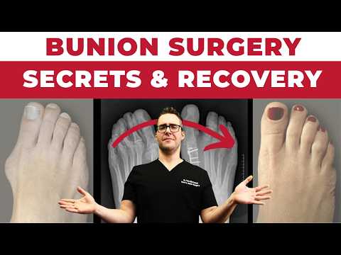 Bunion Surgery SECRETS & FAST Recovery [Bunionectomy vs Lapiplasty]