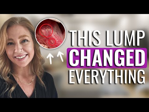 Cancer Took 85% of My Tongue, But NOT My Voice | Beth's Patient Story