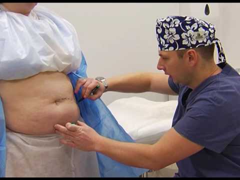 Абдоминопластика