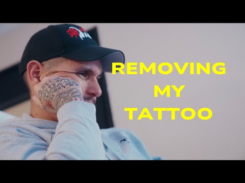 Removing My Tattoo