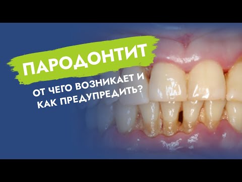 Пародонтит. От чего возникает и как предупредить?