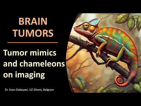 Brain Tumor Mimics on Imaging