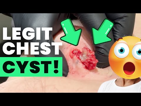 LEGIT CHEST CYST!