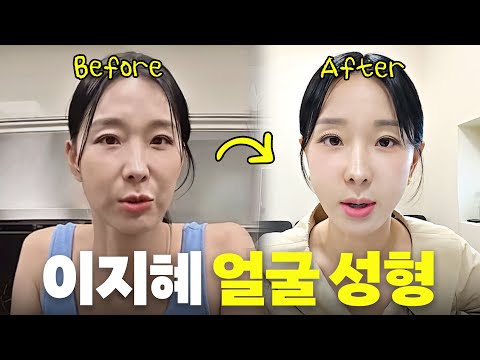 자칭 성형 전문가 45세 이지혜 실리프팅 시술 최초공개(내돈내산, 찐후기) 