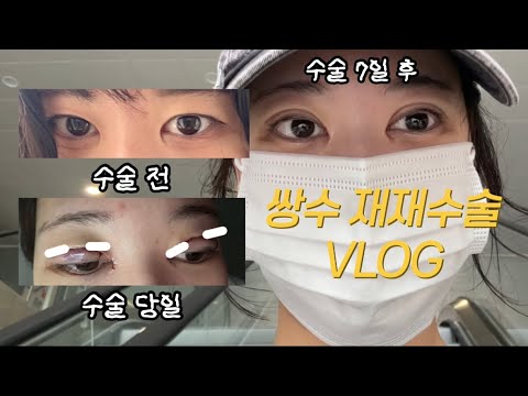 쌍수 재재수술 VLOG(+앞트임, 절개, 부기 변화 과정)