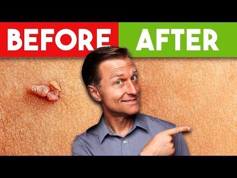 How To Remove Skin Tags And Warts Overnight