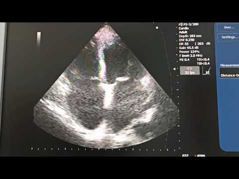 Оценка легочной артерии правого желудочка и предсердий у пациента с фибрилляцией предсердий