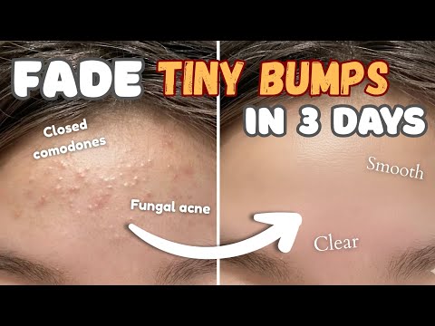 How to get rid of TINY BUMPs on face 🎀 at home NATURALLY || Closed comodones & Fungal acne