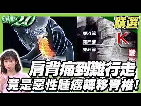 輕忽 頸椎神經壓迫 恐致手腳發麻、癱瘓！肩背痛到難行走 竟是惡性腫瘤轉移脊椎！釋放頸椎壓力這樣動！【健康2.0精選】