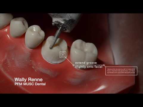 PFM Crown  Prep and animation for Dental Students