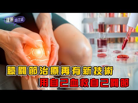 膝關節治療再有新技術 用自己血救自己關節 ｜ 健康關注組 ｜ EP417 ｜ 膝關節退化 ｜ 自體血蛋白溶液 ｜ 敖嘉年 ｜ 黃芳雯 ｜ HOY TV 77台