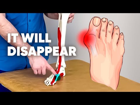 I didn't believe it when I did it. The bunion on my big toe is GONE!