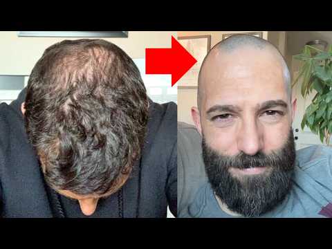 THIS Mans Balding Story Could Save You YEARS Of Suffering