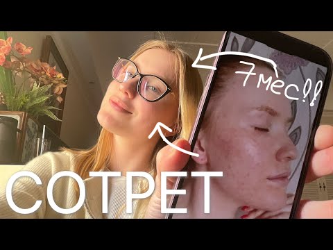 Сотрет:как я избавилась от акне за 7-8месяцев