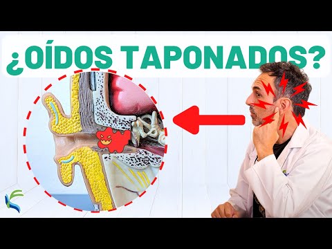 ¿OÍDOS TAPONADOS? 🙉 Remedio natural para eliminar el tapón👂