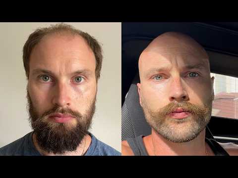 How To Become 10X More Confident Without Hair