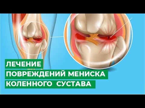 Treatment of meniscus injuries of the knee joint