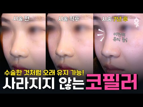 The Best Way to Get a Beautiful Nose Without Surgery! Why We Recommend Nose Fillers