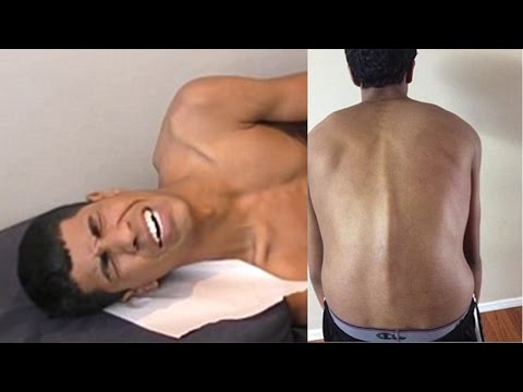 Chiropractor CHANGES LIFE for TEENAGER w/ HUNCHBACK & DEAD LEG