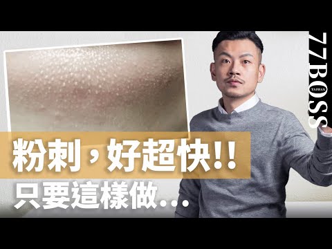閉鎖粉刺要擠嗎？這樣做，粉刺好超快～～！！ 【77老大】