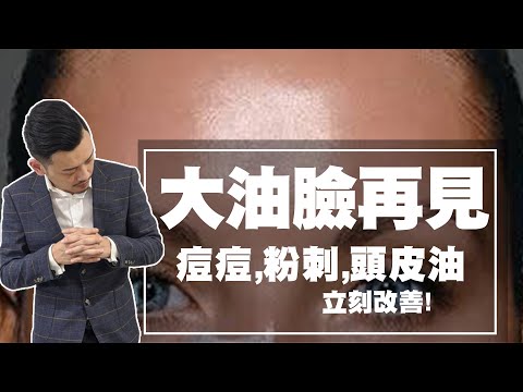 大油臉再見!一周控油改善痘痘、粉刺、頭皮油!【77老大】