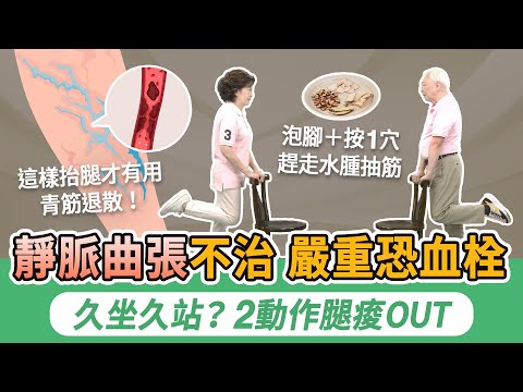 靜脈曲張嚴重恐肺栓塞奪命！40歲以上大多這2個原因。小腿水腫發癢當心血栓！4物泡腳＋按1穴，消水腫防抽筋。穿彈性襪抬腿有用？ 醫師示範2動作，防血管堵塞，緩解水腫痠脹｜胡乃文開講Dr.HU_269