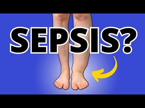 Alert! Foot/Ankle Swelling & Edema Can Cause Serious Sepsis; Know This