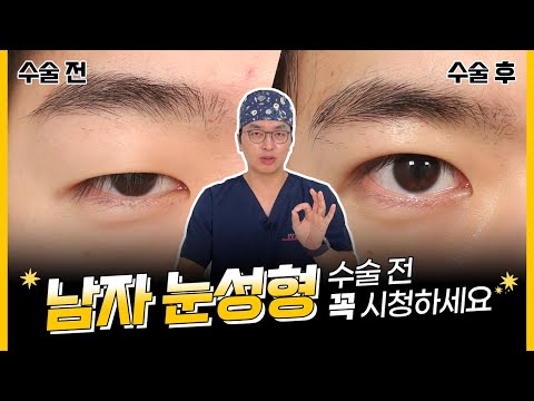 남자 눈성형, 수술 전 필수시청! (무쌍or속쌍, 눈매교정, 부기, 흉터)