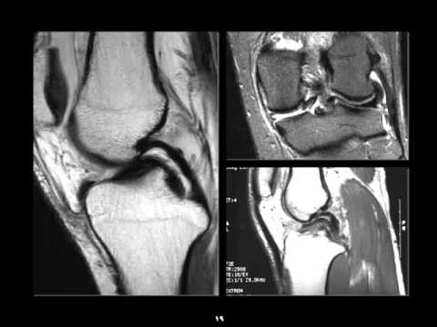 MRI of the knee part 1 march 2015 DR. AMR SAADAWY